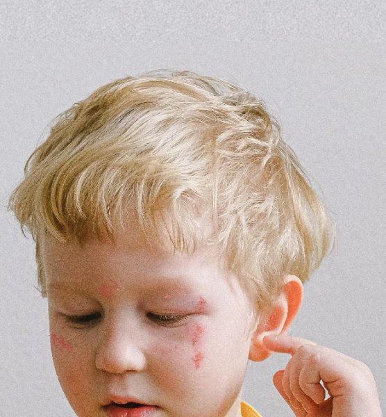 Jak se zbavit ekzému - důležitá je správná diagnóza 2