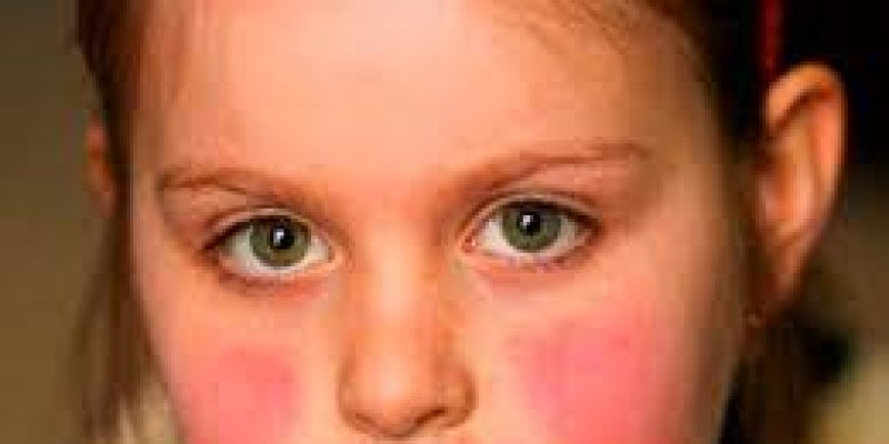 Krupičková vyrážka na obličeji 1